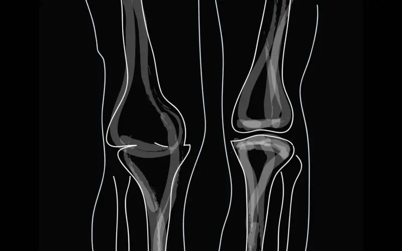 Iyengar yoga video thumbnail: Iyengar Yoga for Treating Symptoms of Osteoarthritis of the Knees: A Pilot Study